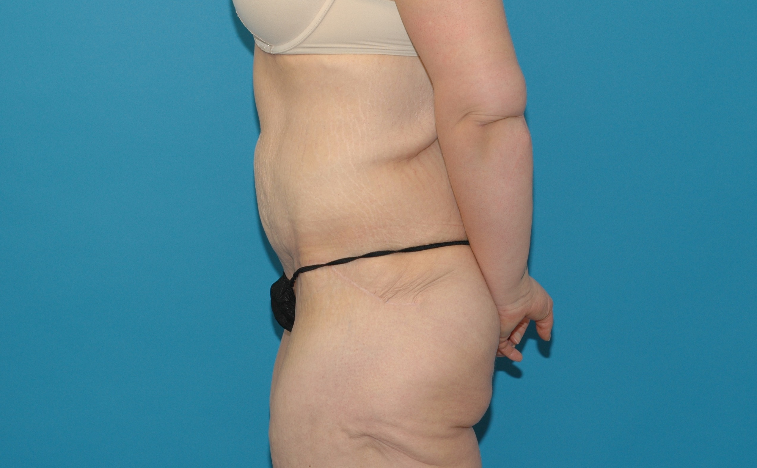 Gallery - After Weight Loss  Sattler Plastic Surgery, Seattle