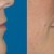 Lip Augmentation with Juvederm