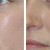 Cheek Injections with Juvederm and Voluma