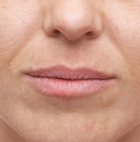 Cosmetic Facial Injections  Sattler Plastic Surgery, Seattle