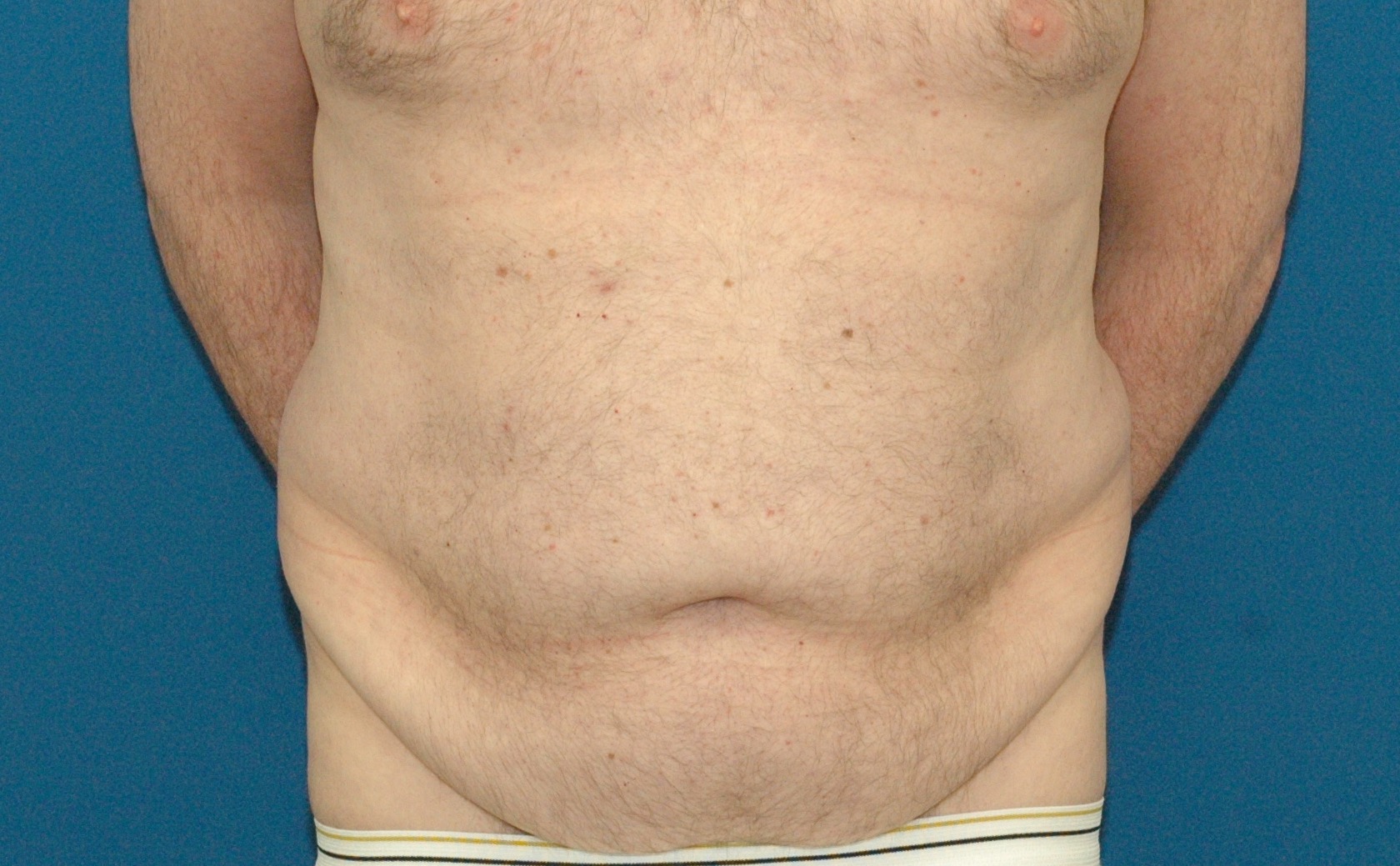 Body Contouring after Weight Loss - the male patient