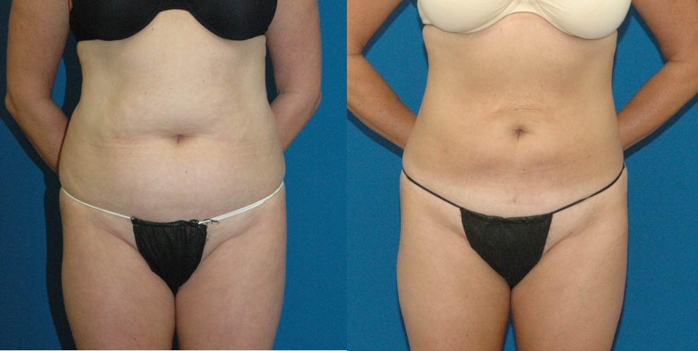 Liposuction For Back Fat In Bellevue