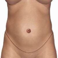 tummytuck_procedure1.jpg