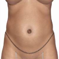 tummytuck_procedure7.jpg